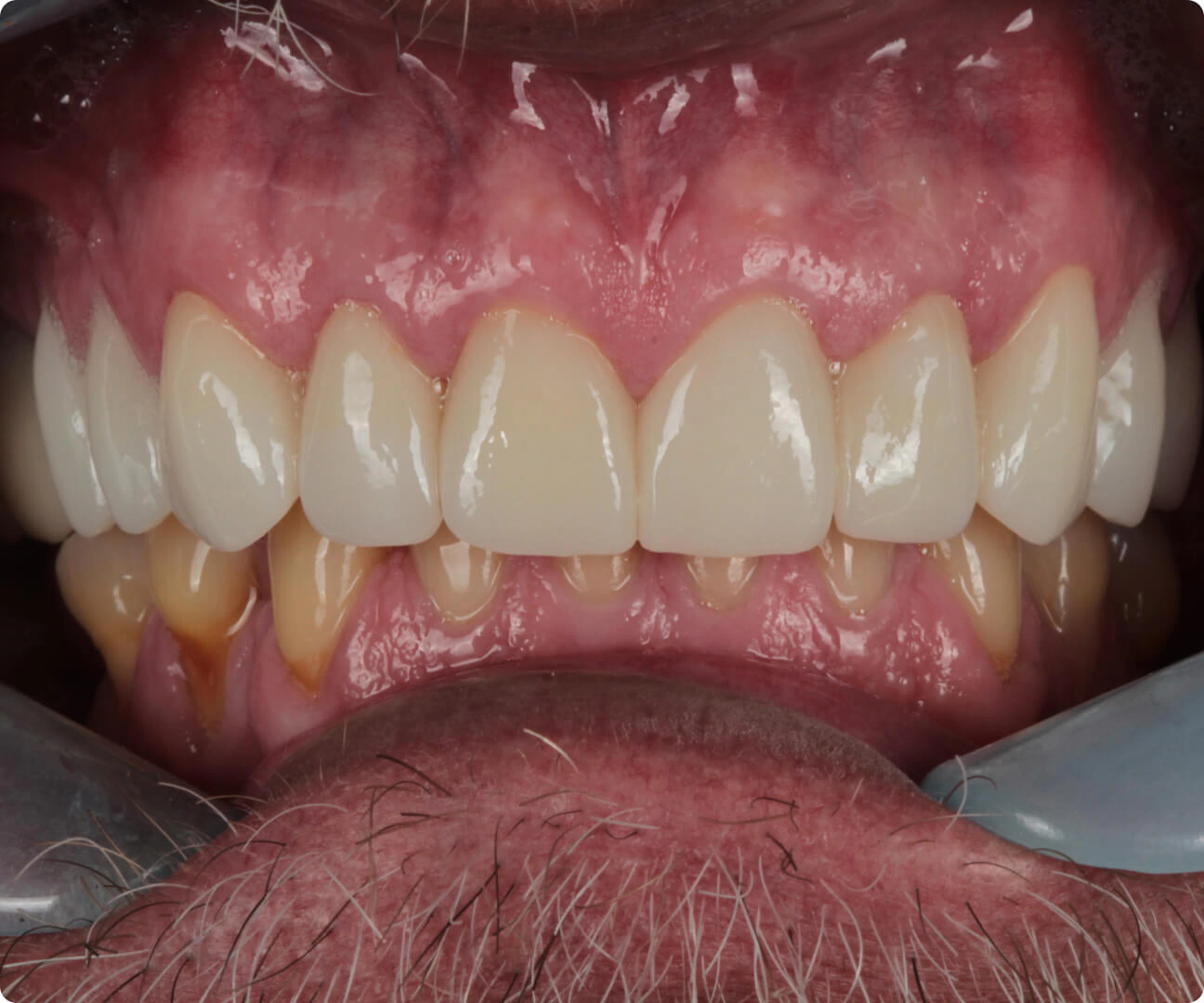 Teeth after Dandy restoration
