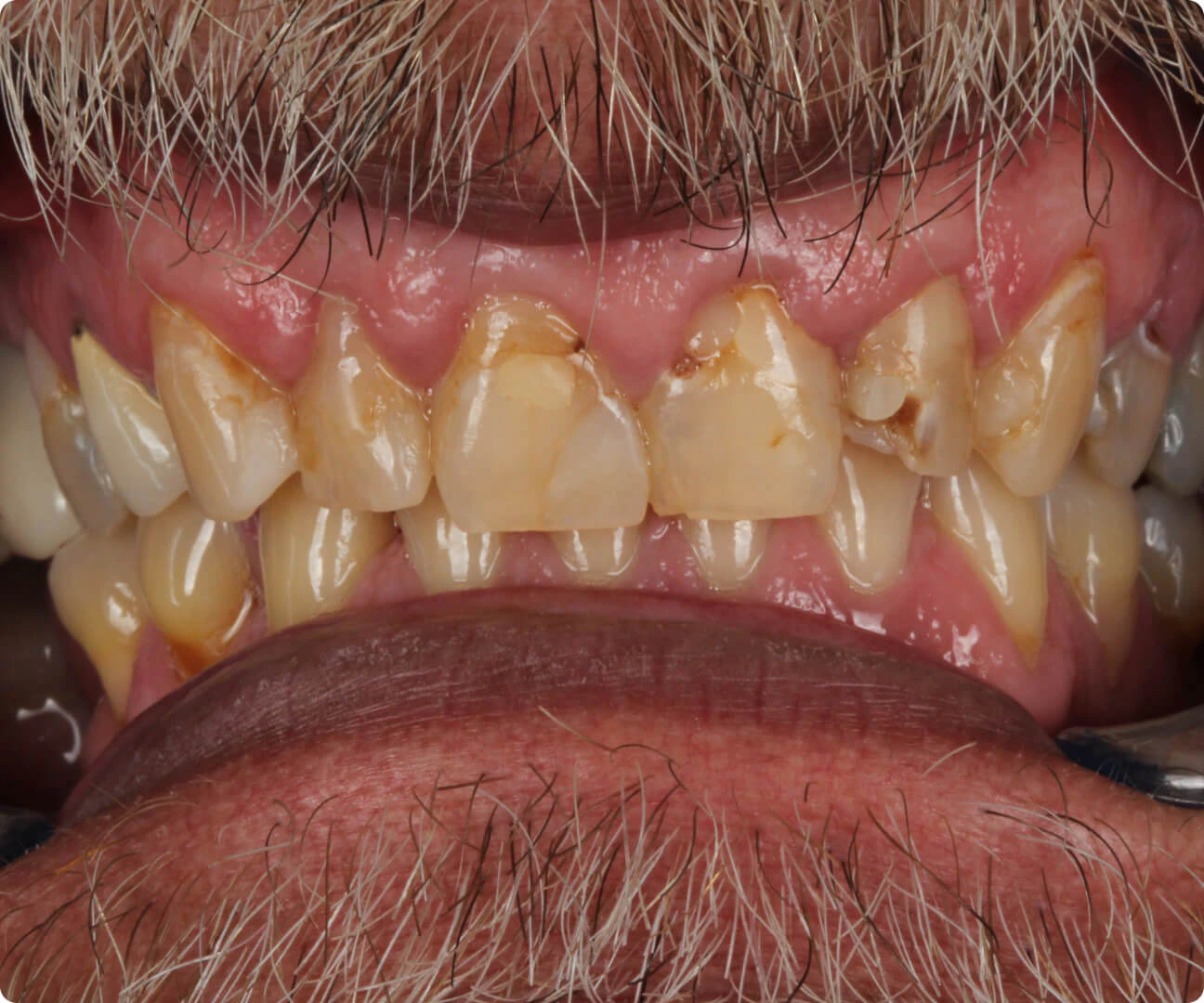 Teeth before Dandy restoration