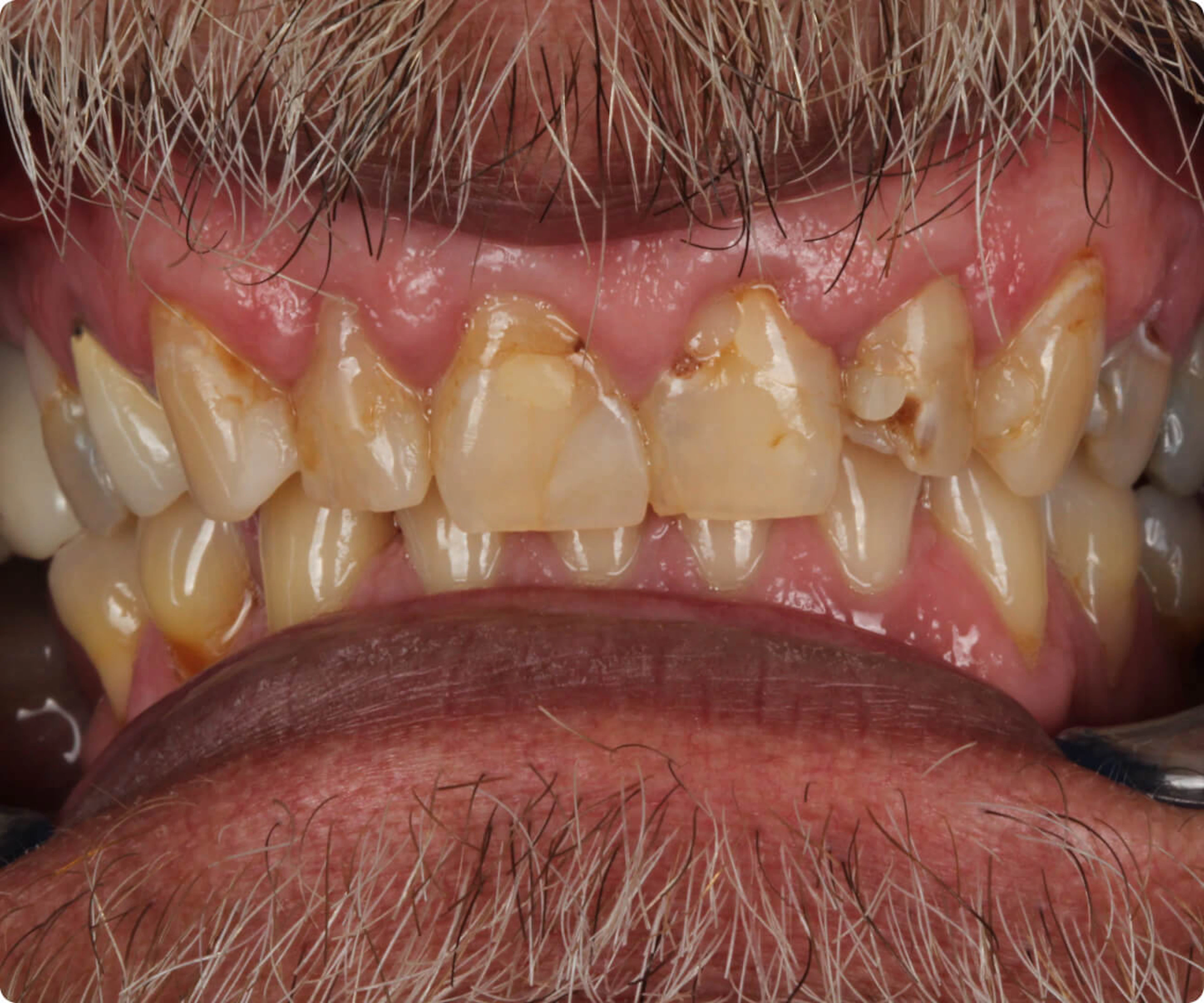 Teeth before Dandy restoration