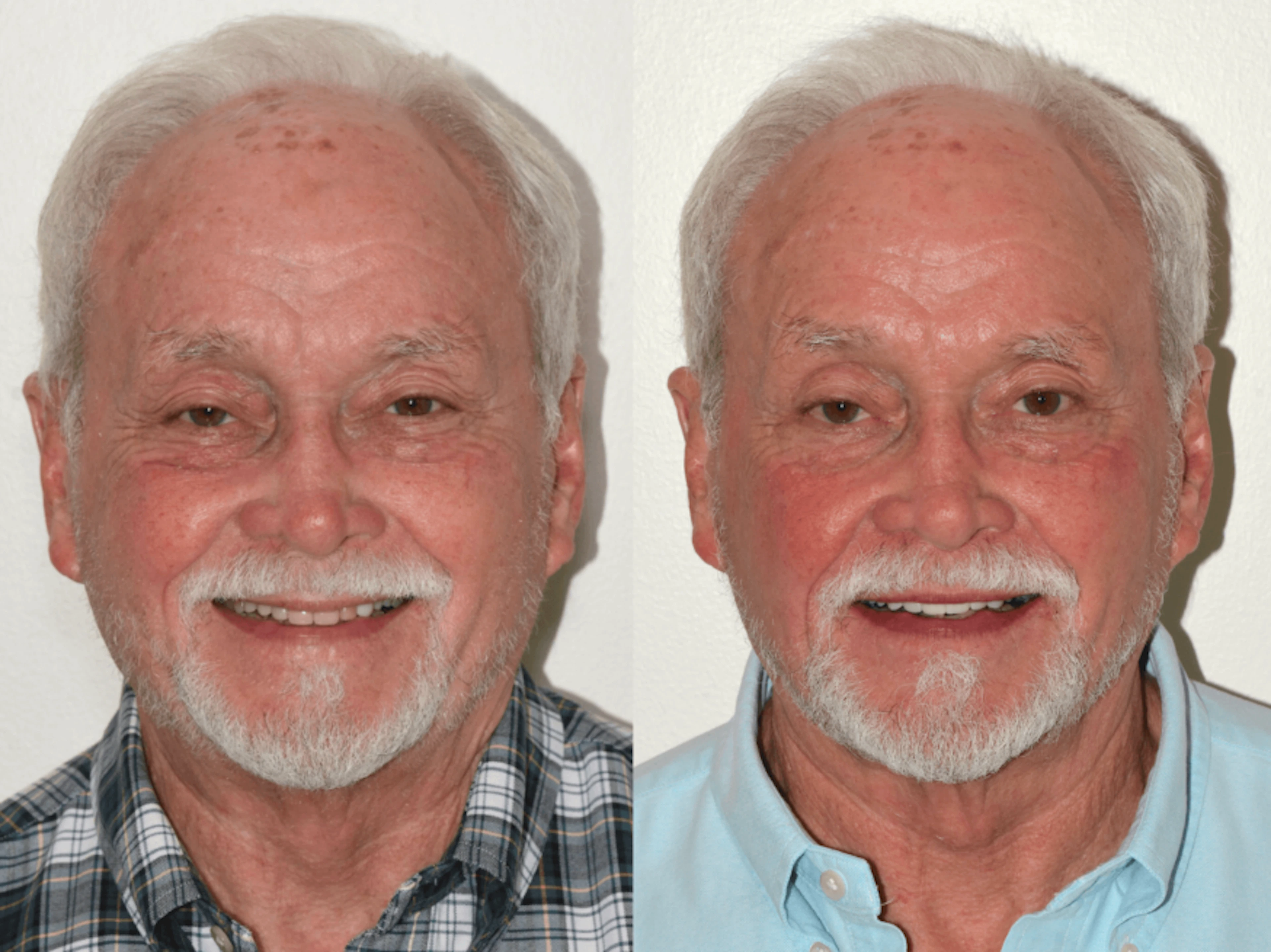 Case Study: Comprehensive Restorative Care with Veneers, Crowns, and Implants