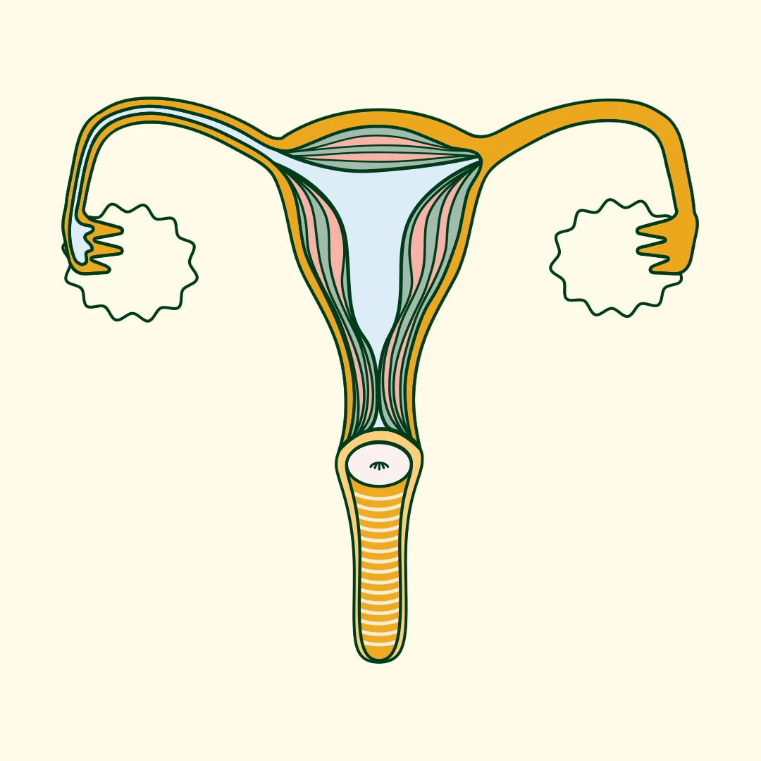 PCOS hirsuitism