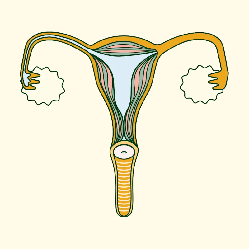 PCOS hirsuitism
