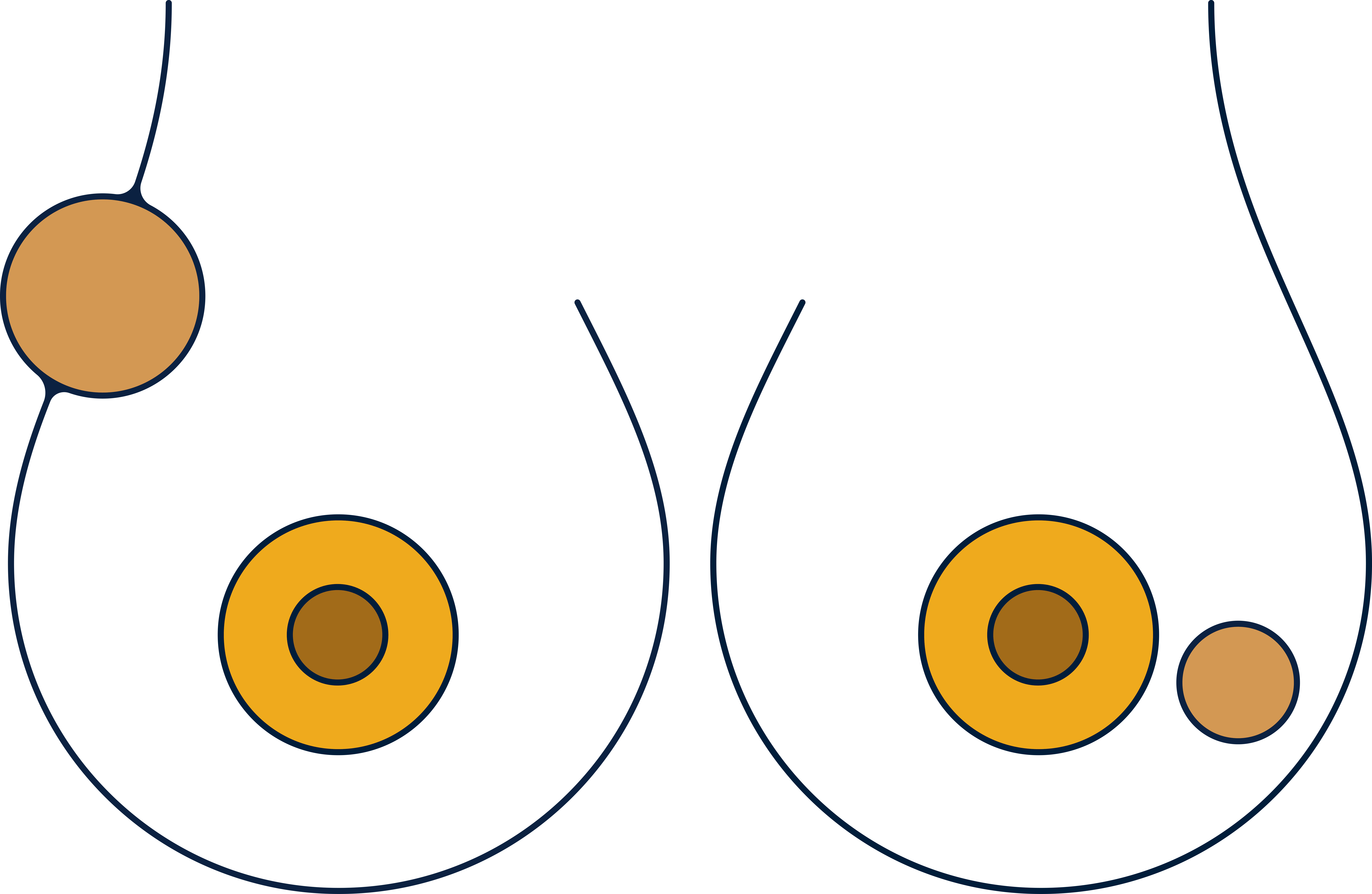 Breast cancer symptoms: lumps and thickening