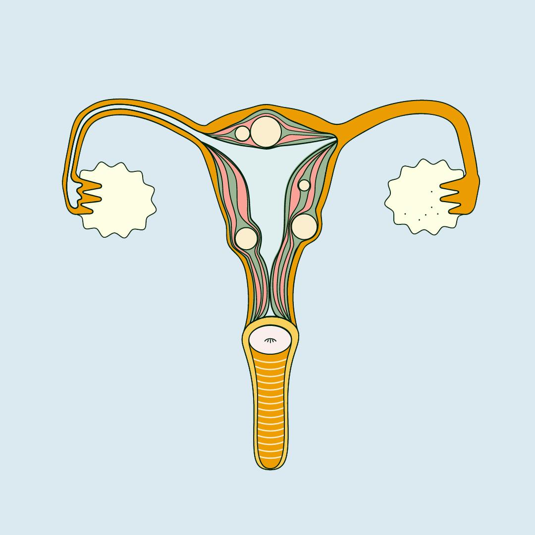 What Are Uterine Fibroids?