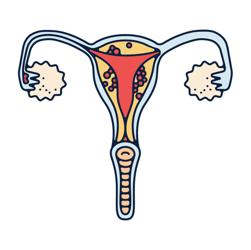 endometriosis illustration