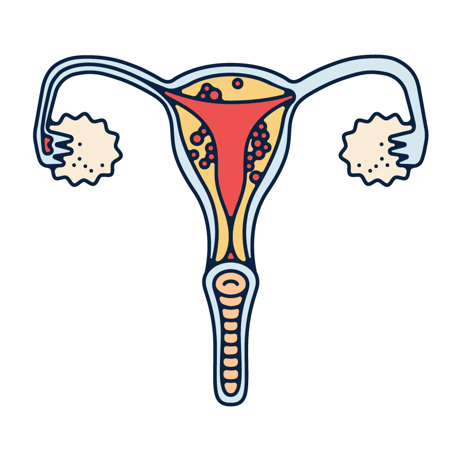 endometriosis illustration