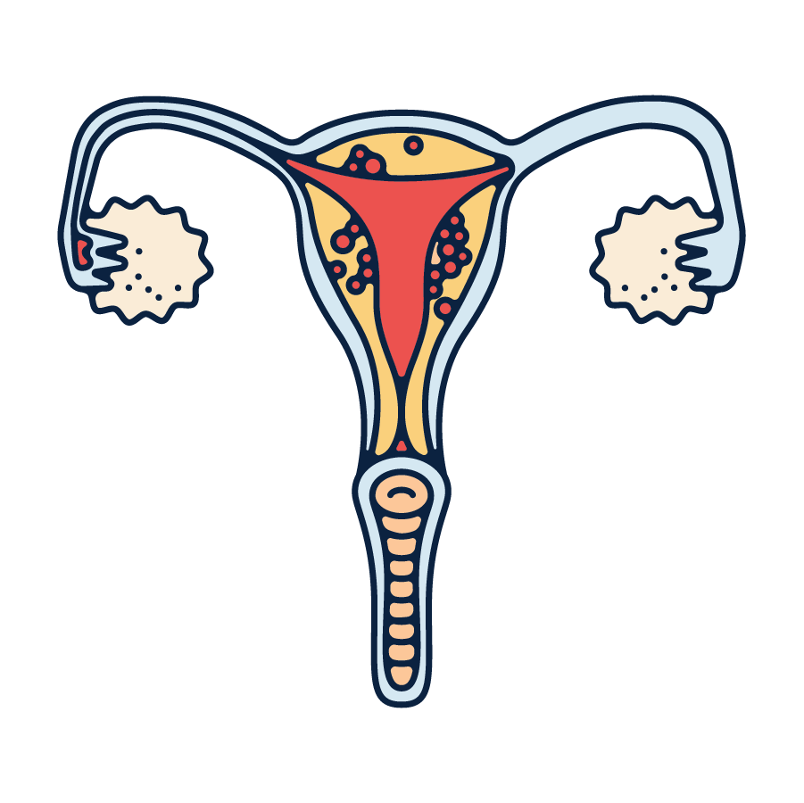 endometriosis illustration