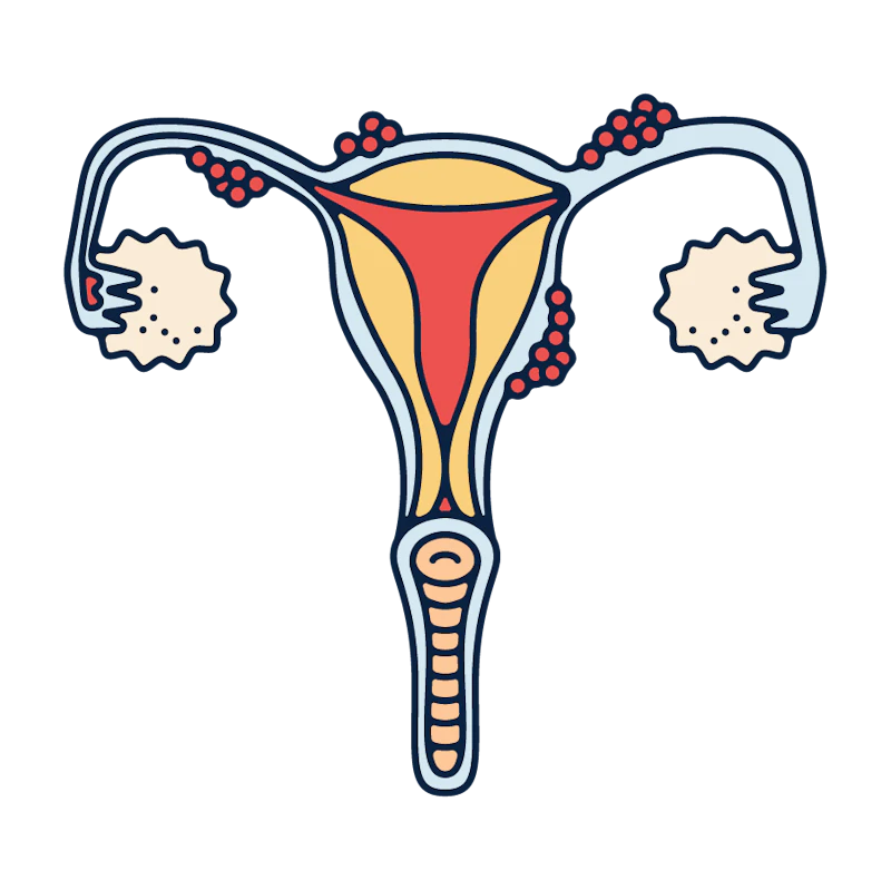 Adenomyosis Illustration