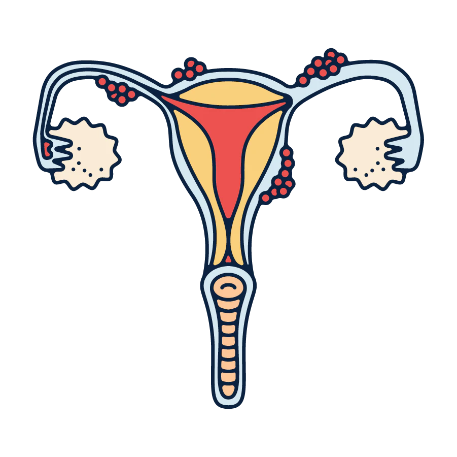 Adenomyosis Illustration