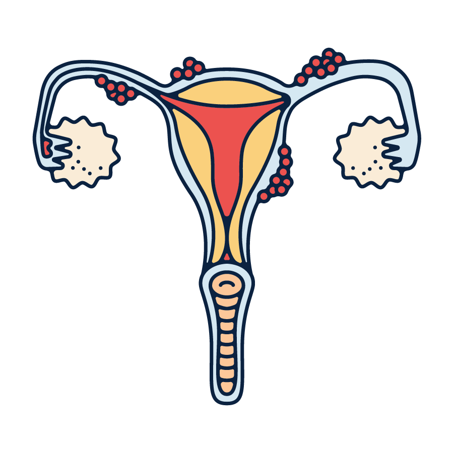 Adenomyosis Illustration