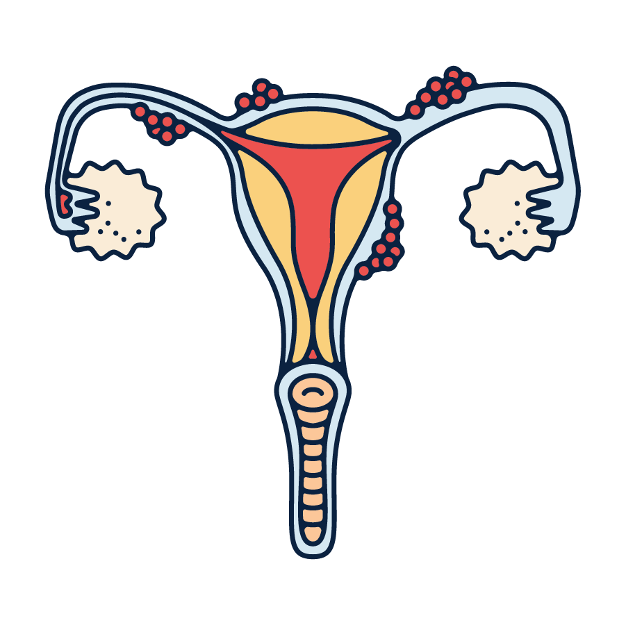 Adenomyosis Illustration 