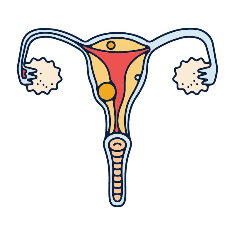 uterine fibroids illustration