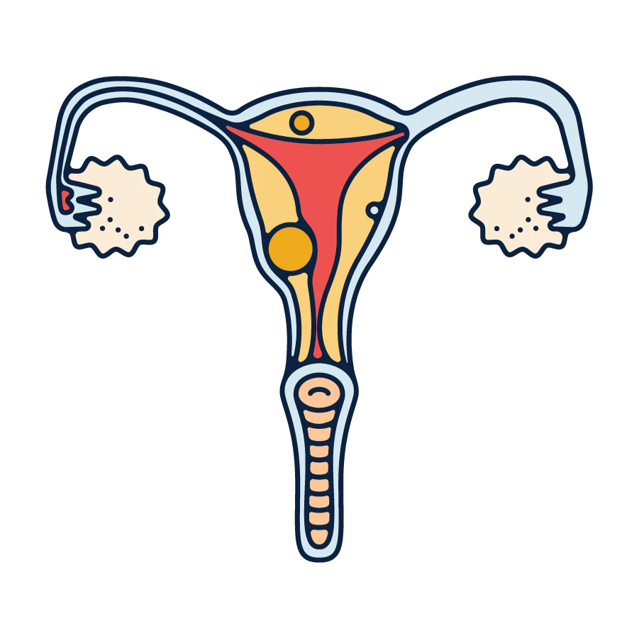 uterine fibroids illustration
