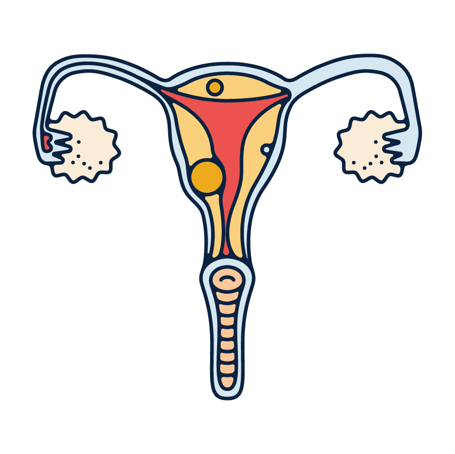 uterine fibroids illustration