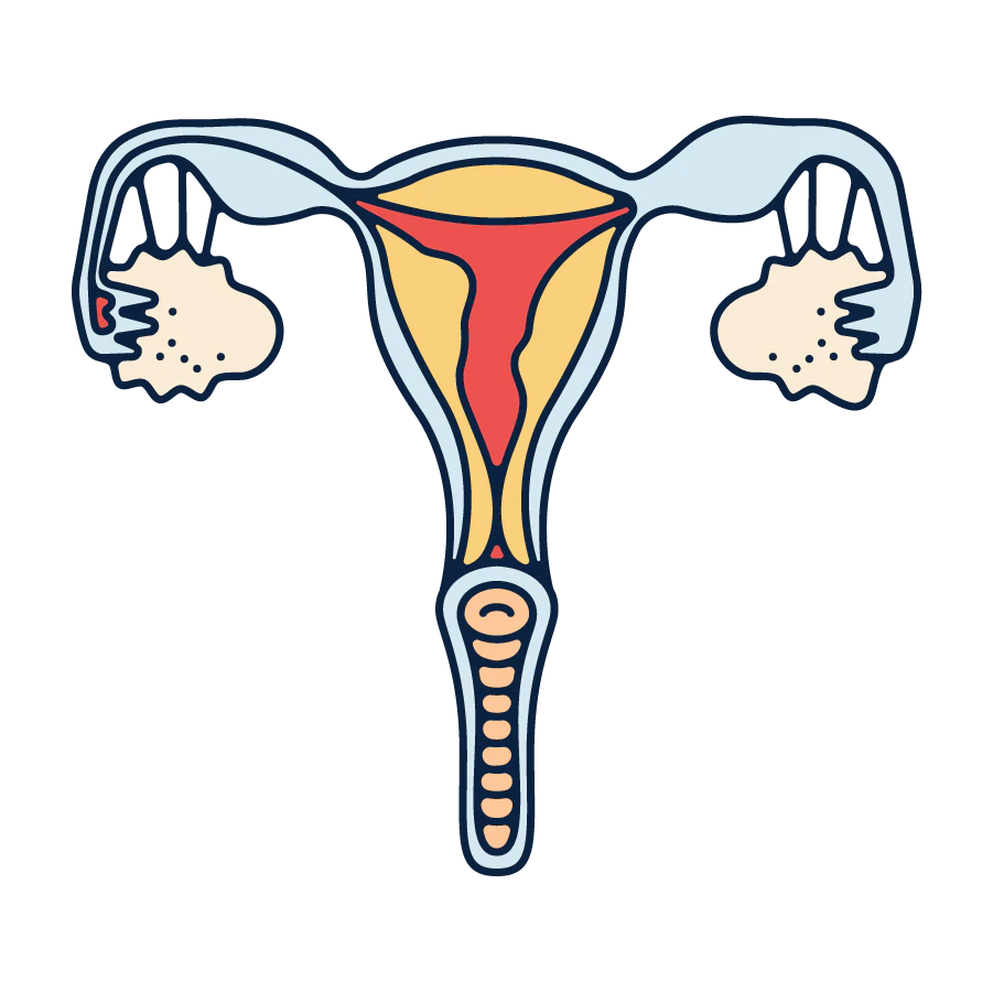 Pelvic inflammatory disease (PID) Illustration