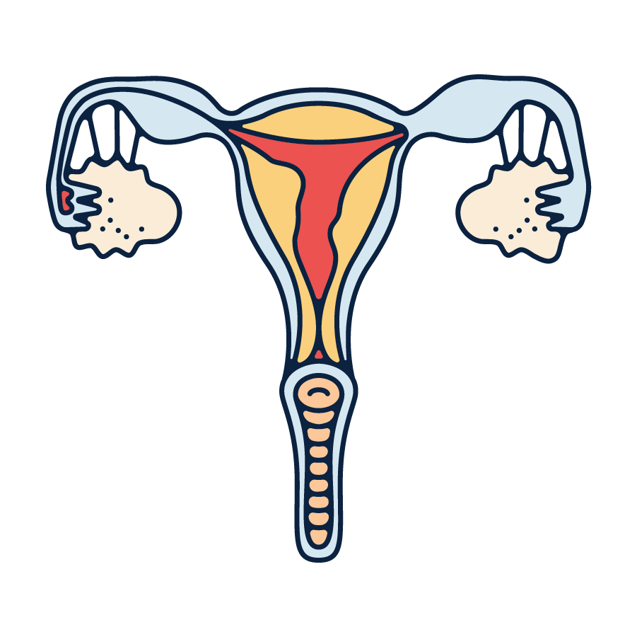 Pelvic inflammatory disease (PID) Illustration