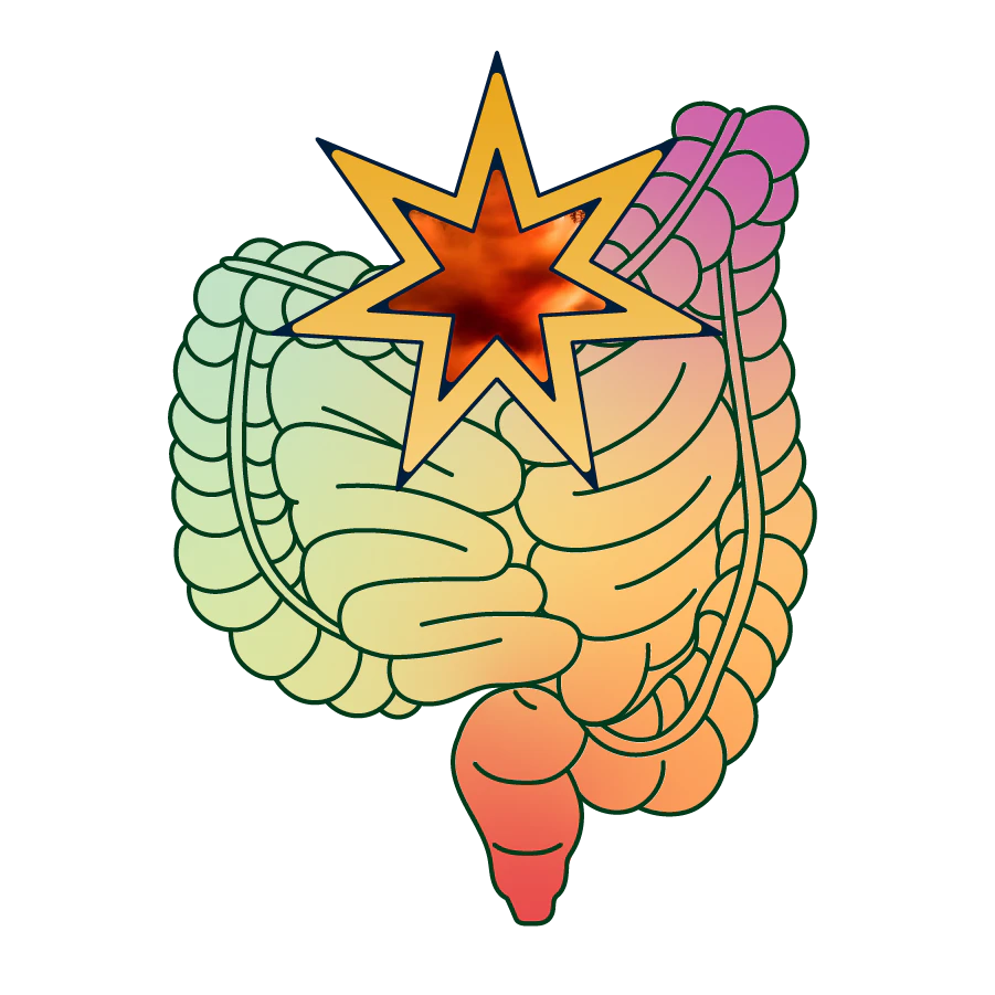 Inflammatory bowel disease illustration