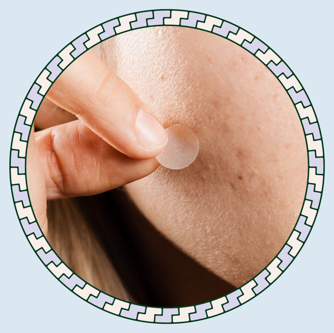 hormonal acne hero image