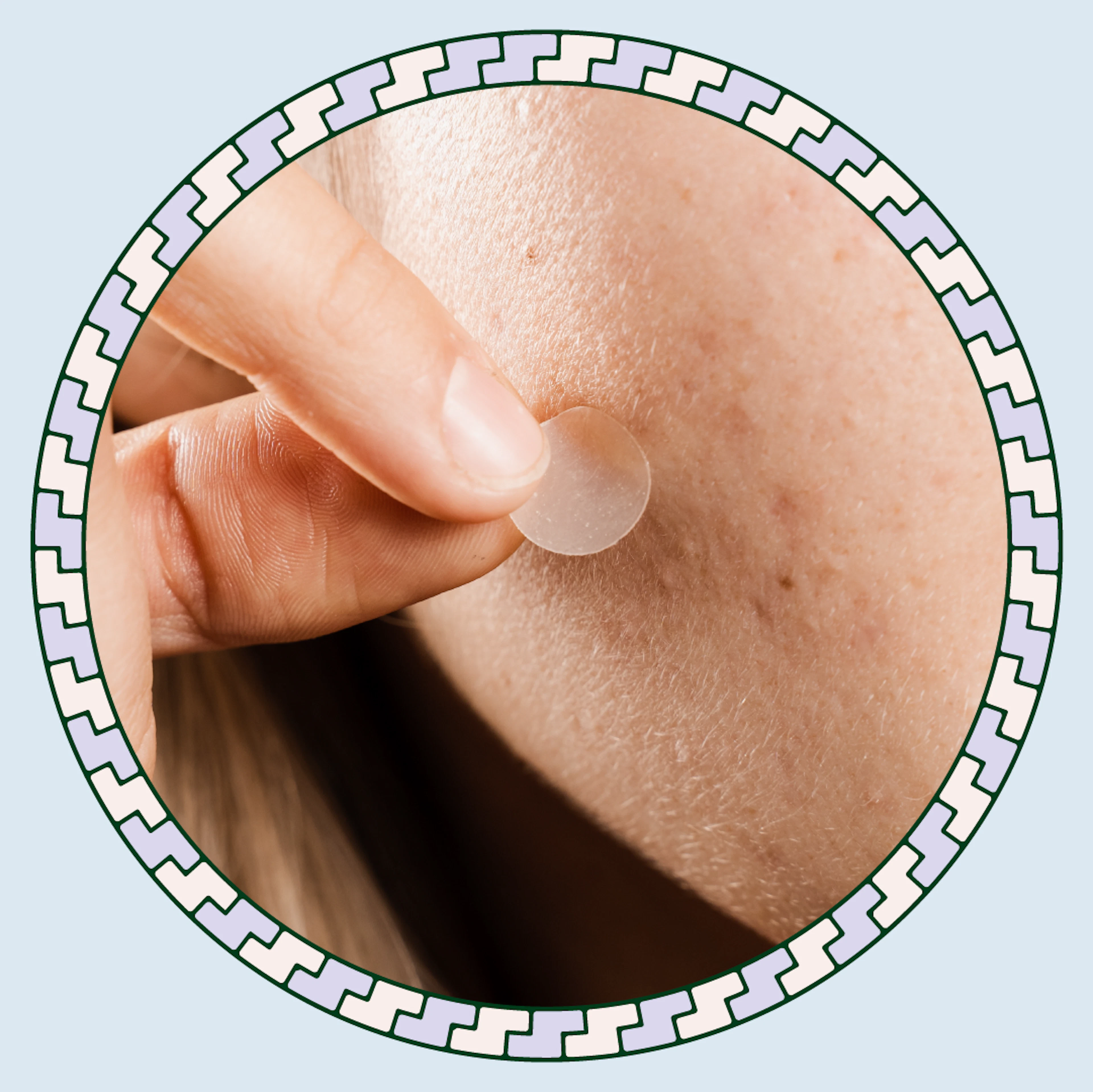 hormonal acne hero image