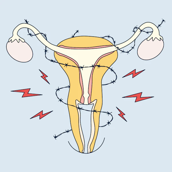 endometriosis
