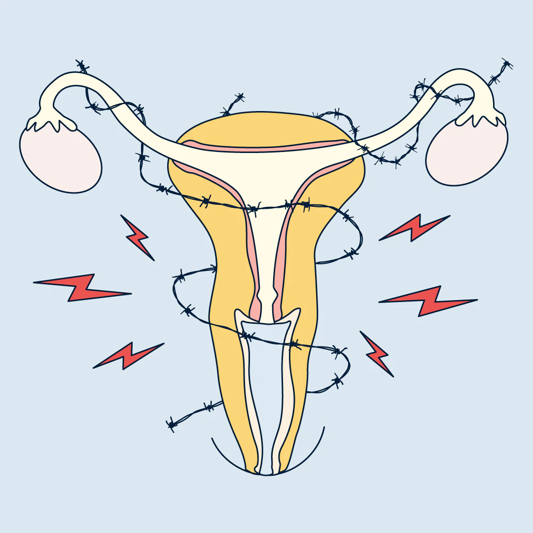 Decoding Your Period Pain: How Hormonal Imbalance Can Signal Endometriosis