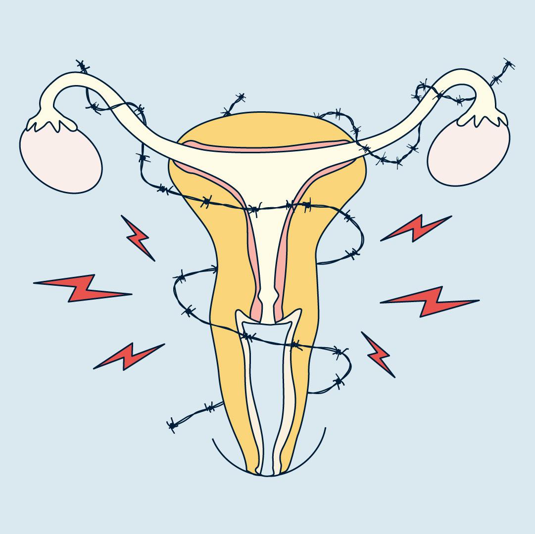 Decoding Your Period Pain: How Hormonal Imbalance Can Signal Endometriosis