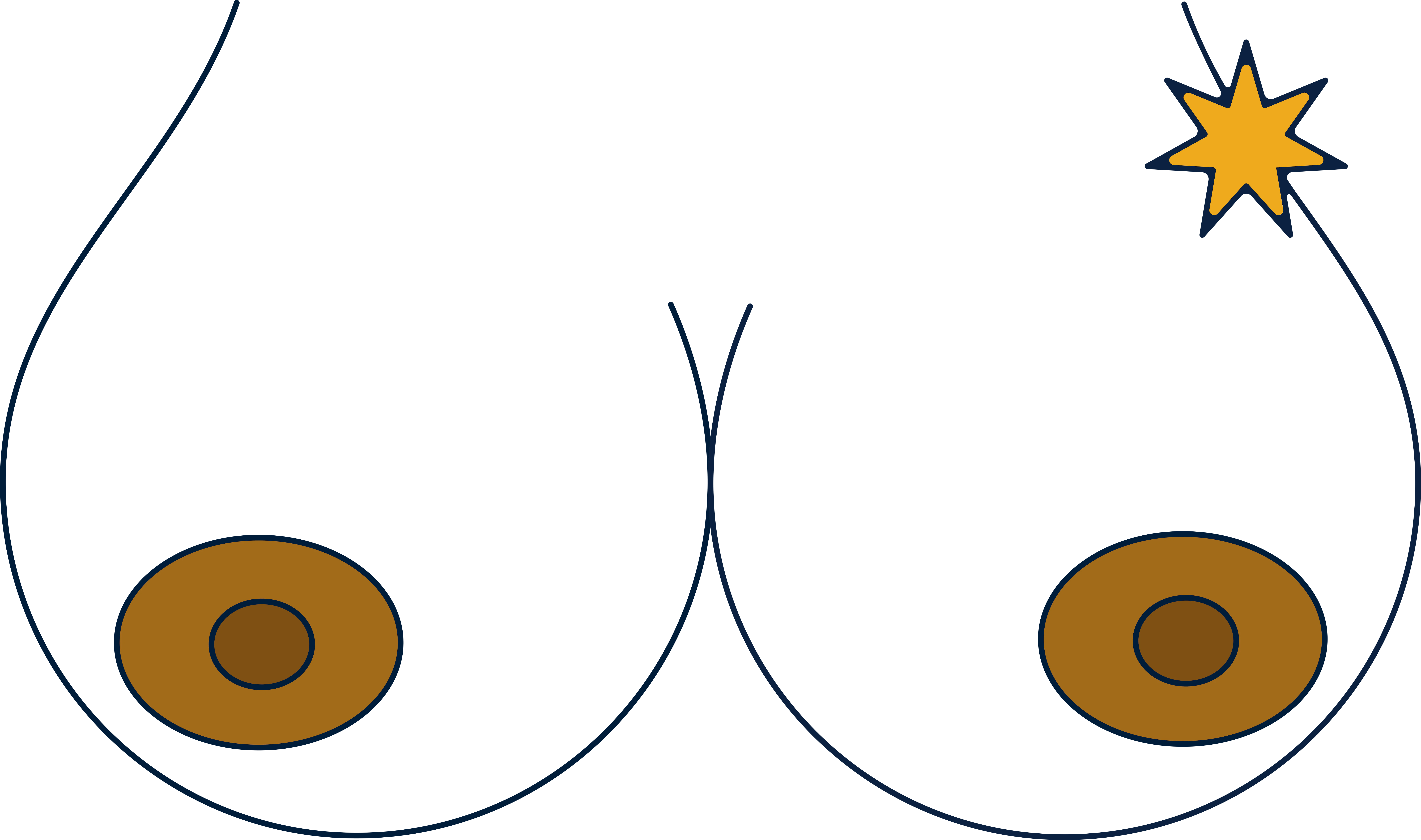 Breast pain, sign of breast cancer