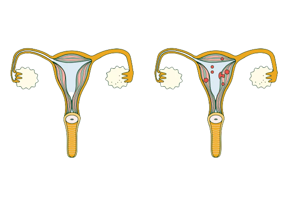 adenomyosis-painful-periods
