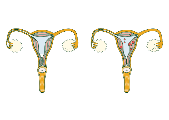 adenomyosis-painful-periods