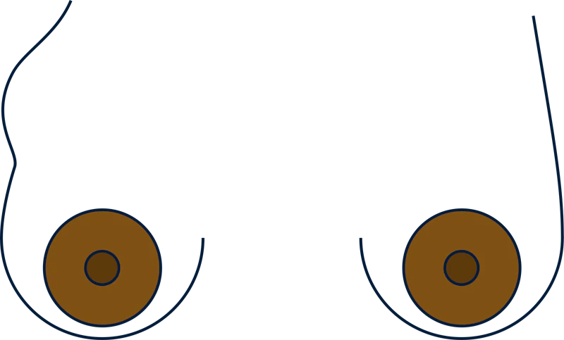Breast swelling