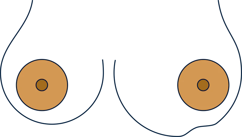 Change in size and shape of breast