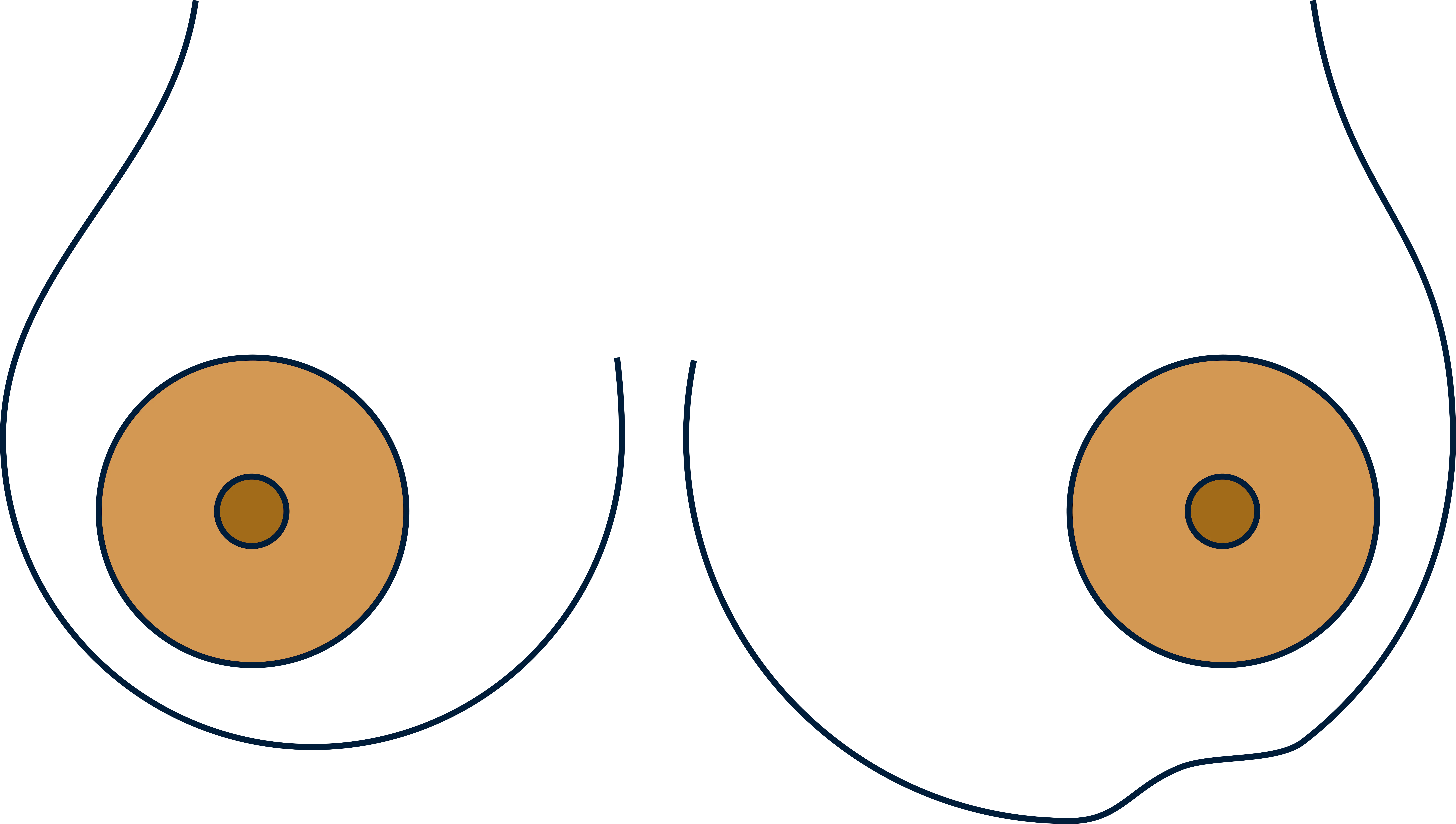 Change in size and shape of breast