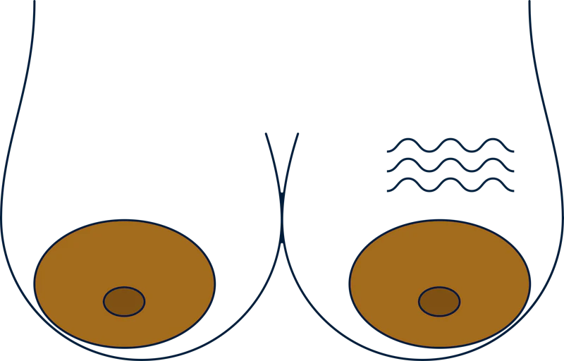 Changes in breast skin texture, signs of breast cancer