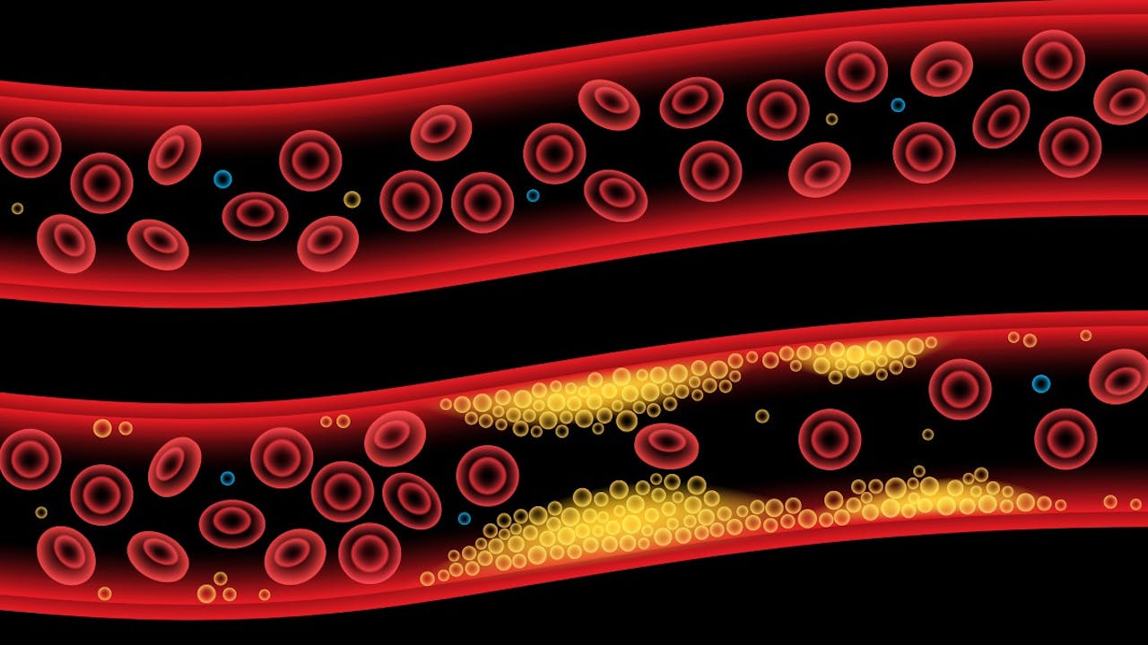 Hiperlipidemia - ¿Qué es y como tratarla?