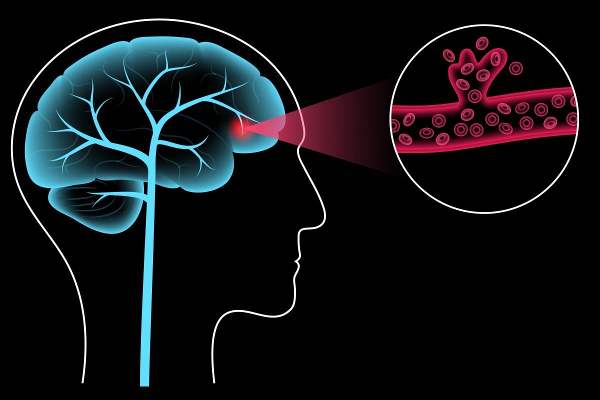 Diabetes y Accidente Cerebrovascular (ACV)