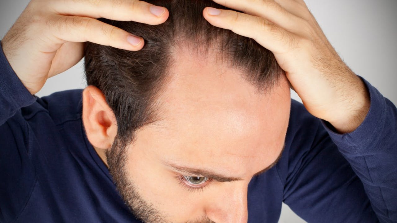 Cómo Detener La Pérdida De Cabello Por La Diabetes