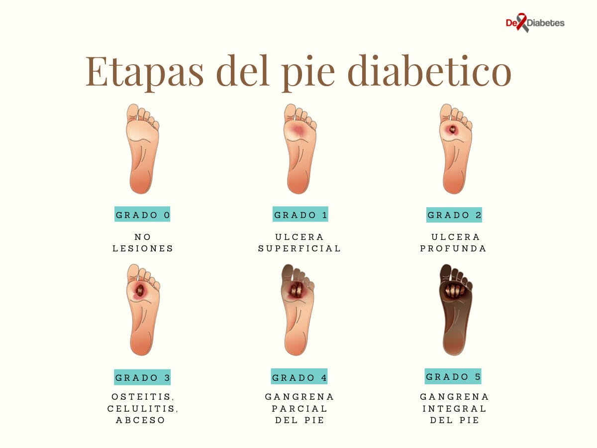 evolución de úlceras del pie diabético, clasificación Wagner