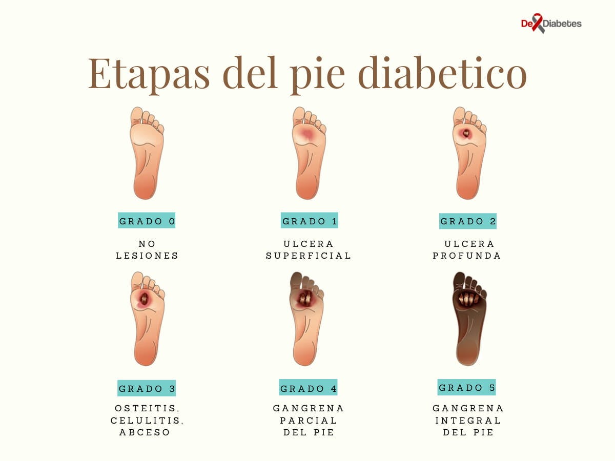 evolución de úlceras del pie diabético, clasificación Wagner