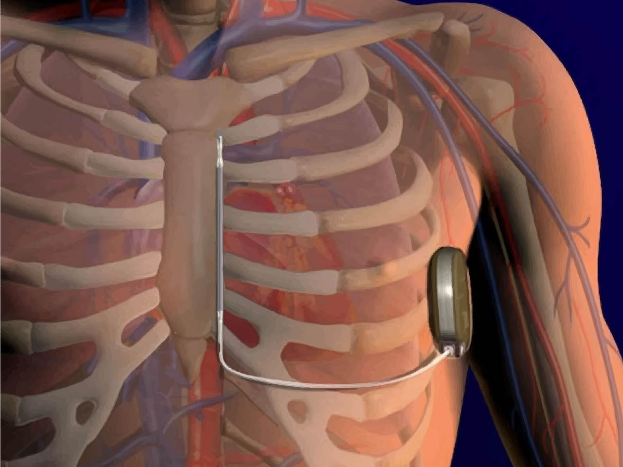 Come funziona un defibrillatore sottocutaneo o SICD