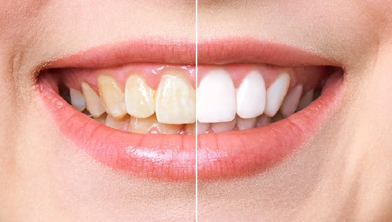 comparație Dinți albi | Dental Hygiene Center