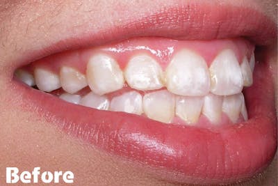 demineralizare dinti - inainte de procedura | Dental Hygiene Center