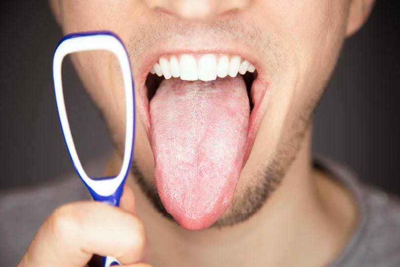barbat cu Limba alba incarcata | Dental Hygiene Center