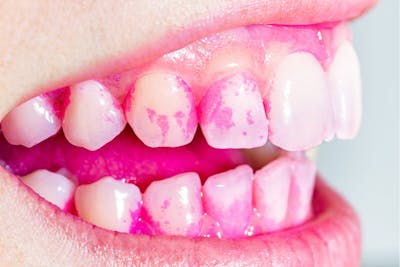 Dinti cu placa bacteriana colorata prin GBT | Dental Hygiene Center