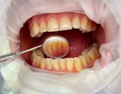 Igienizare dentara - inainte de procedura | Dental Hygiene Center