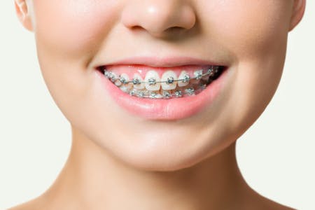 Aparat dentar | dental Hygiene Center