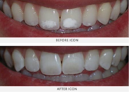 Icon - Inainte is dupa procedura | Dental Hygiene Center