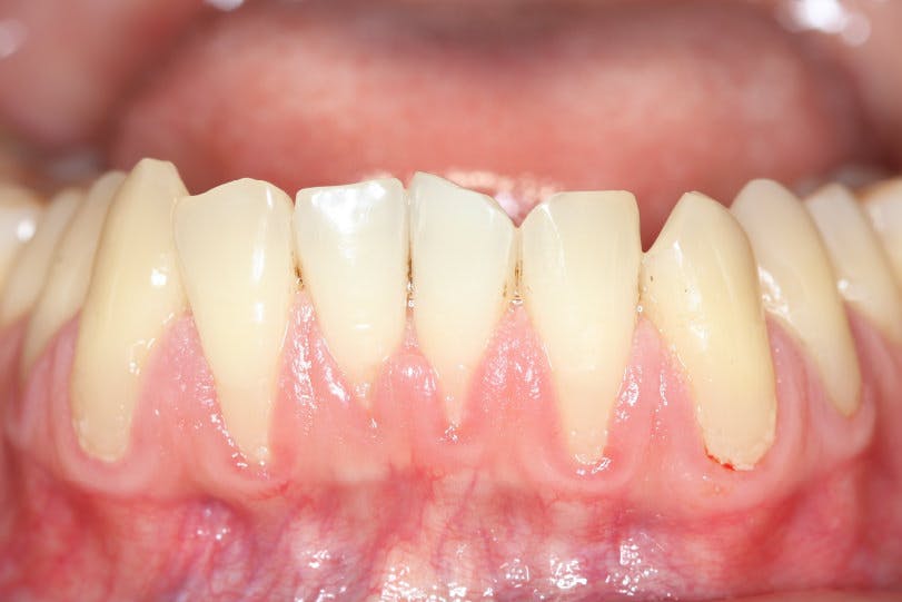 Dinti expusi dupa retractie gingivala | Dental Hygiene Center