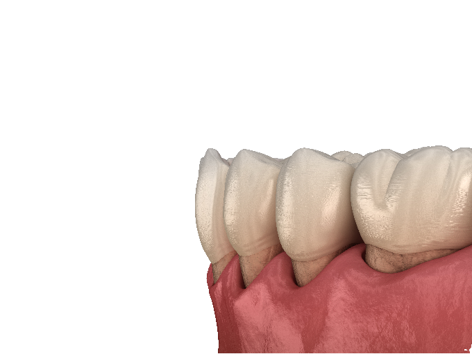 Poti preveni retractia gingivala! 