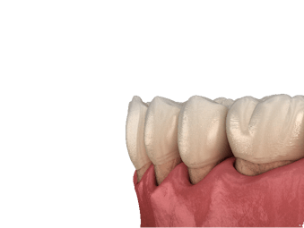 Poti preveni retractia gingivala!