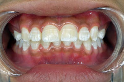 Pete albe pe dinti / fluoroza dentara | Dental Hygiene Center
